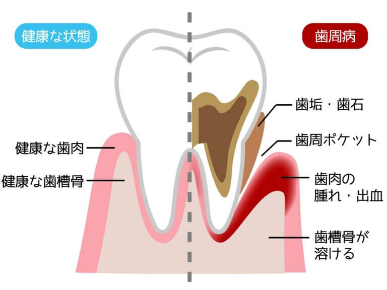 歯周病の定義