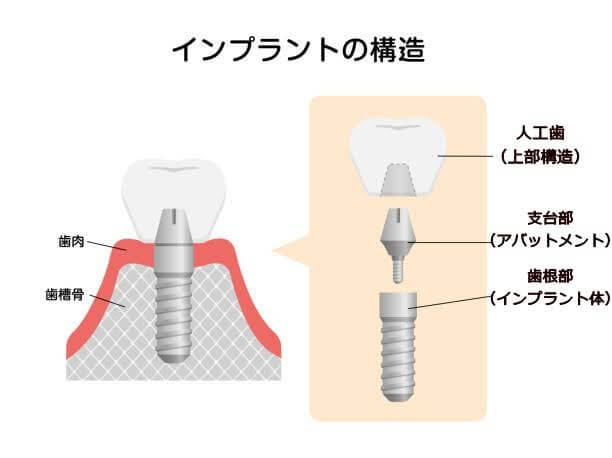 インプラントの構造