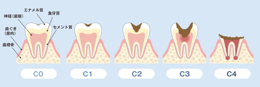 虫歯の進行段階