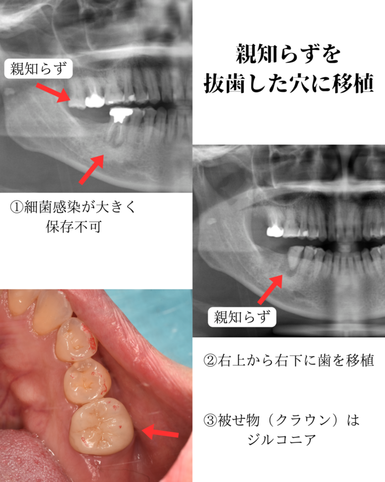 歯の移植