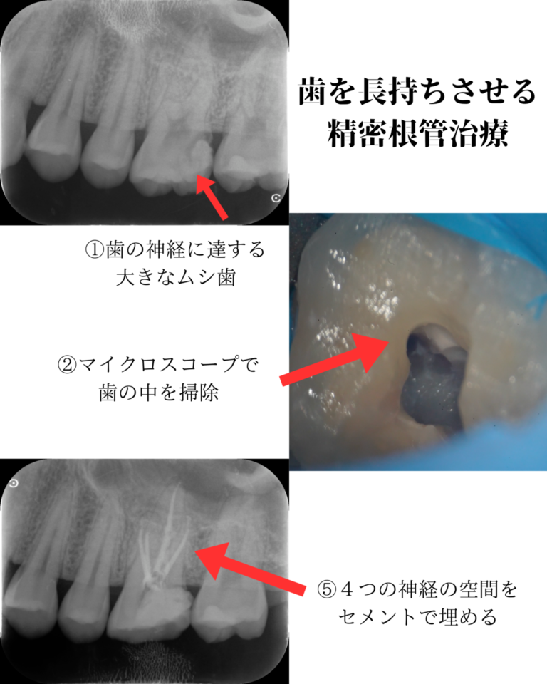 精密根管治療