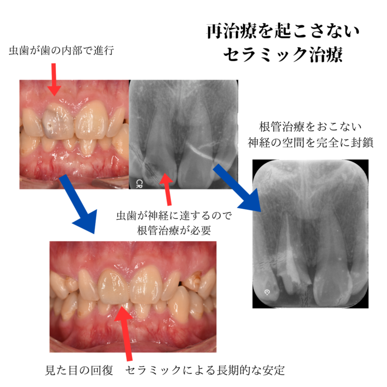 セラミック治療