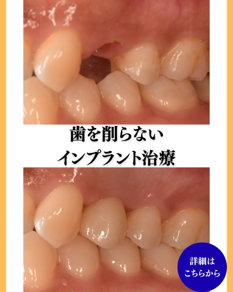 インプラント治療