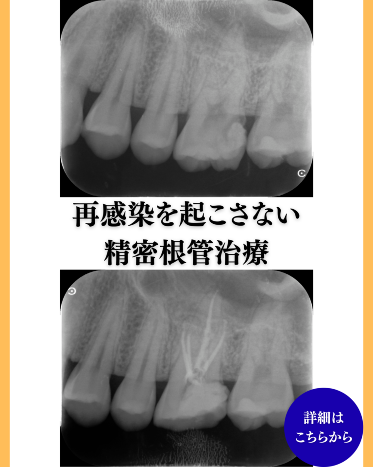 精密根管治療
