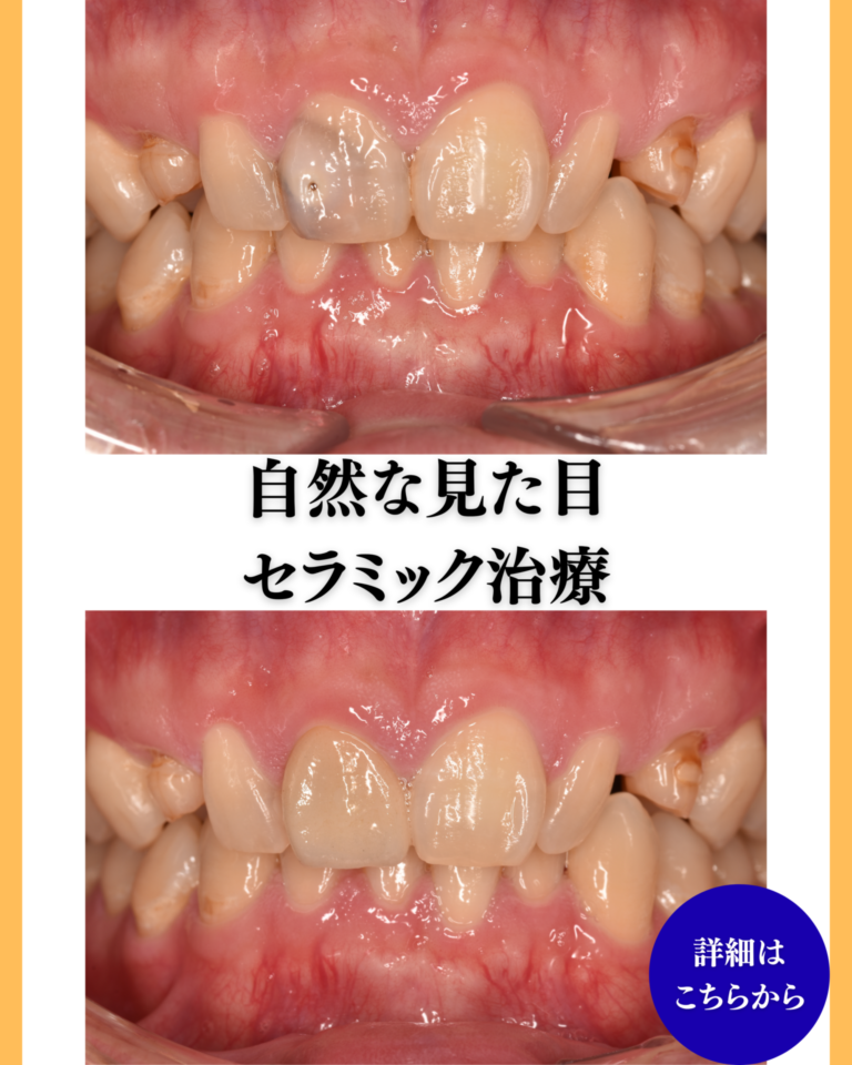 セラミック治療
